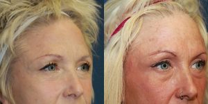 Before and After Image