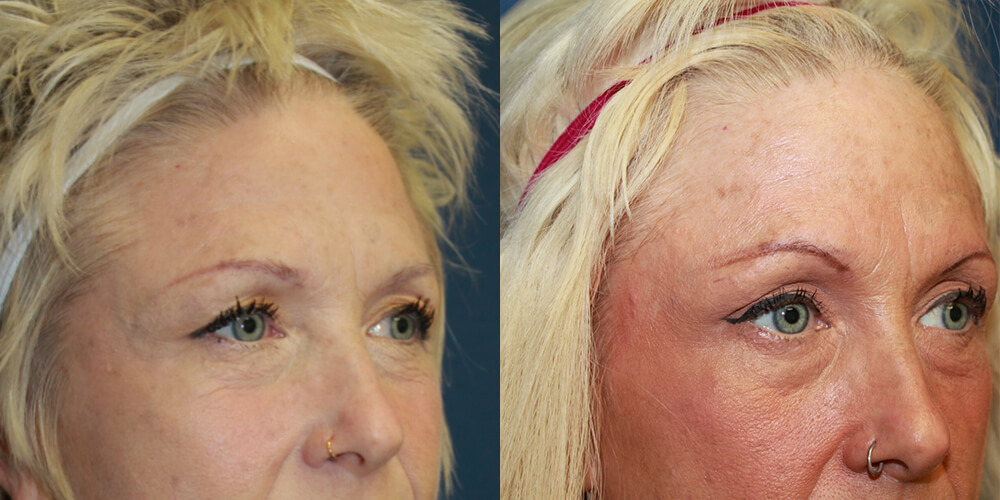 Before and After Image