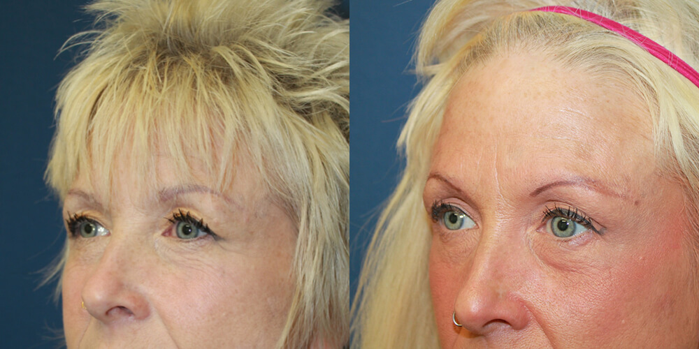 Before and After Image