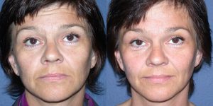 Before and After Image