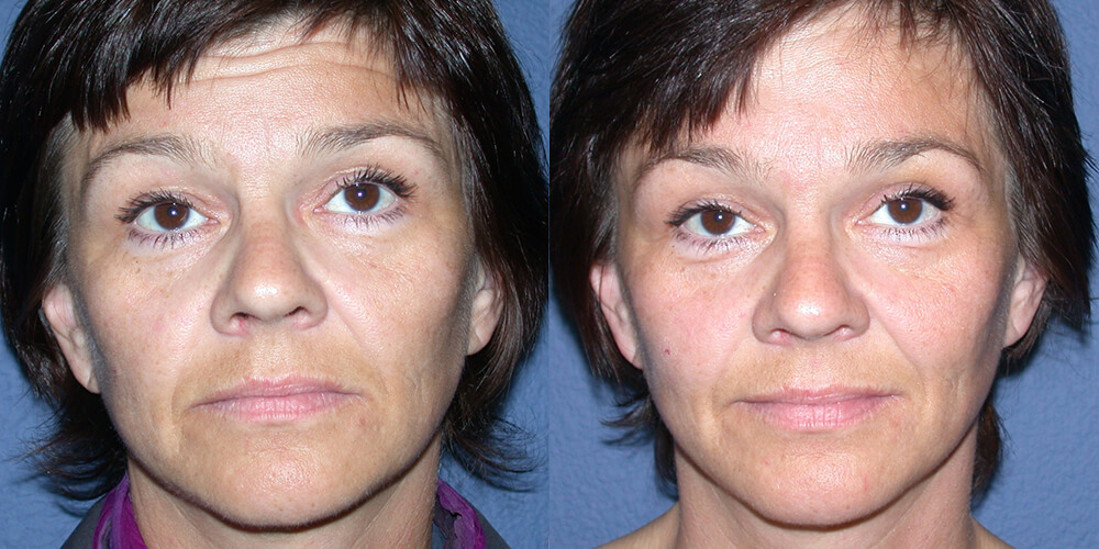 Before and After Image