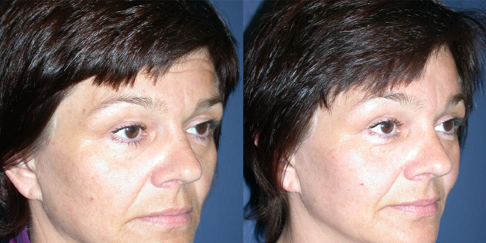 Before and After Image