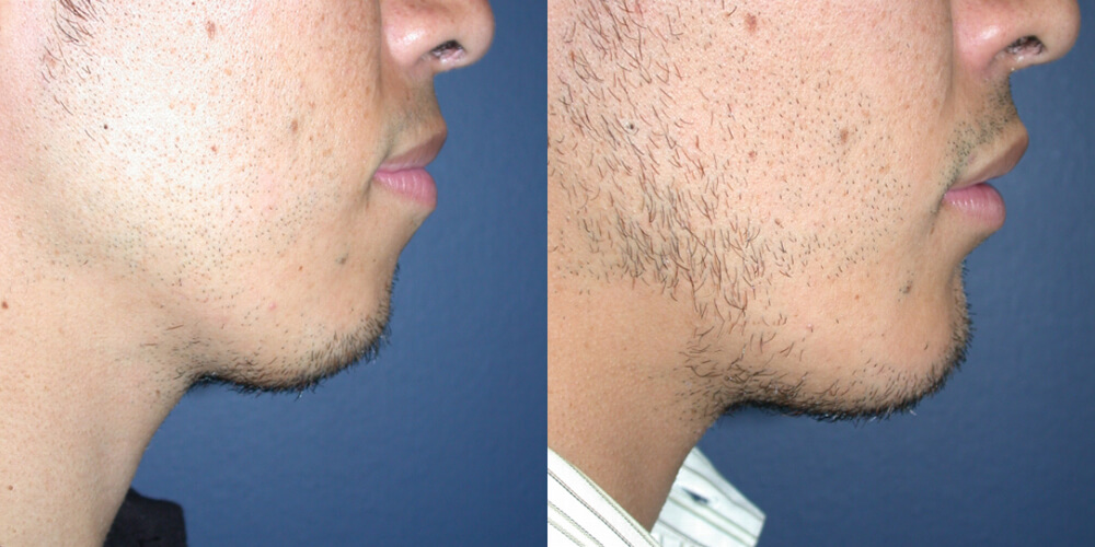 Before and After Image