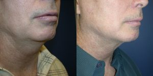 Before and After Image