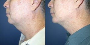 Before and After Image