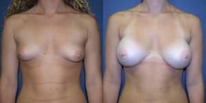 Before and After Image