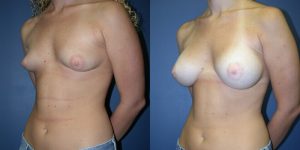 Before and After Image