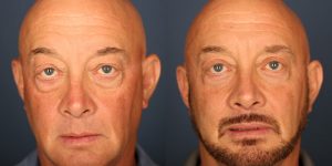 Before and After Image