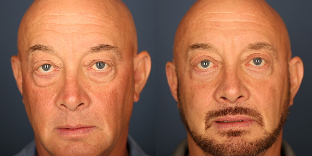 Before and After Image