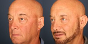 Before and After Image