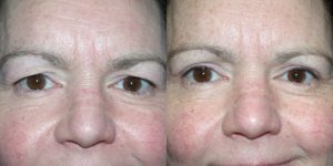 Before and After Image