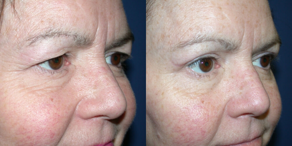 Before and After Image