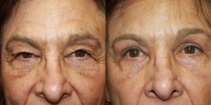 Before and After Image