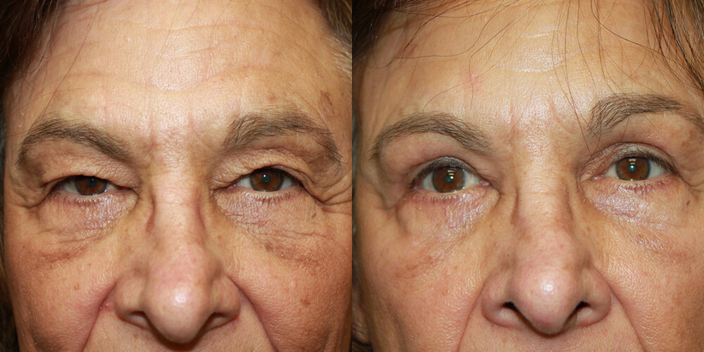 Before and After Image