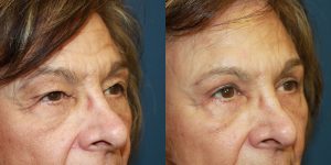 Before and After Image