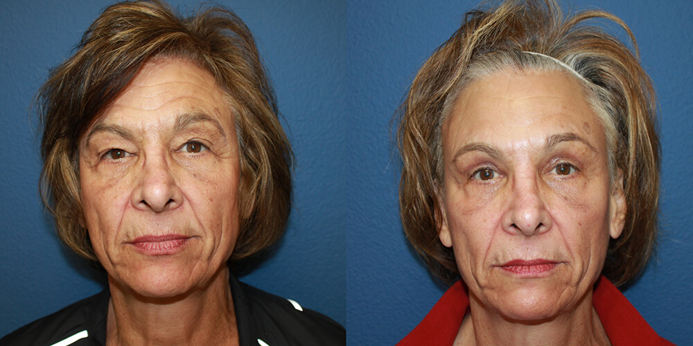 Before and After Image