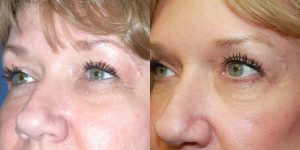 Before and After Image