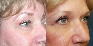 Before and After Image