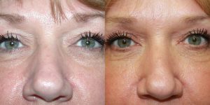 Before and After Image