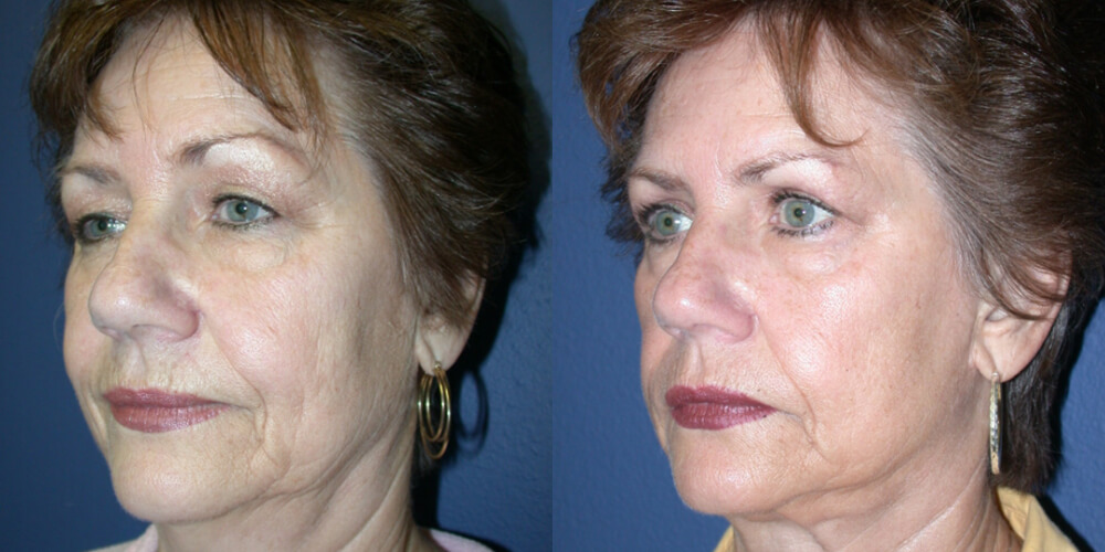 Before and After Image