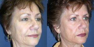 Before and After Image