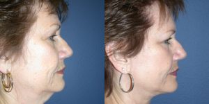 Before and After Image