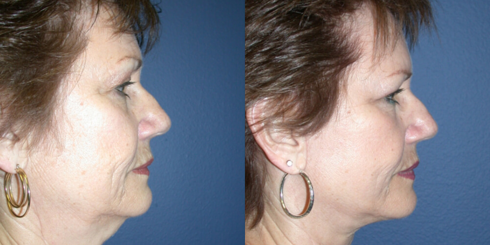 Before and After Image