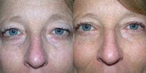 Before and After Image