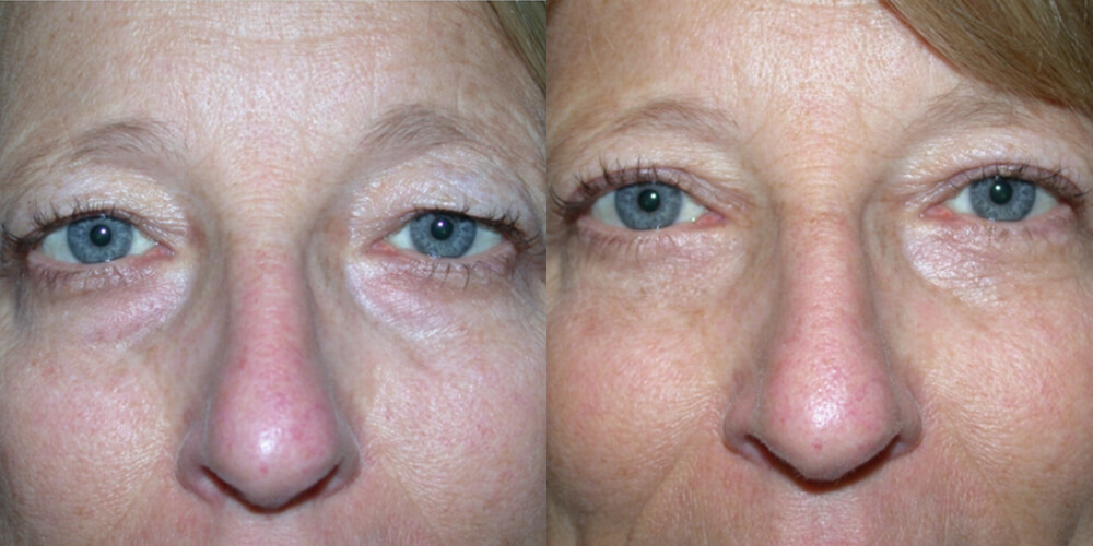 Before and After Image