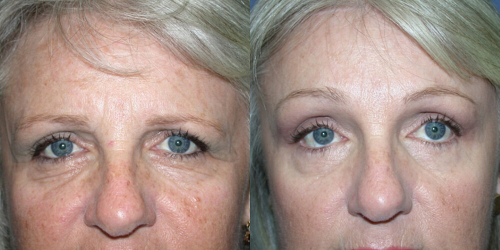 Before and After Image