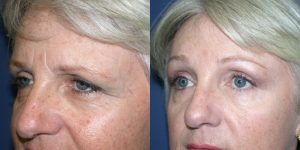 Before and After Image