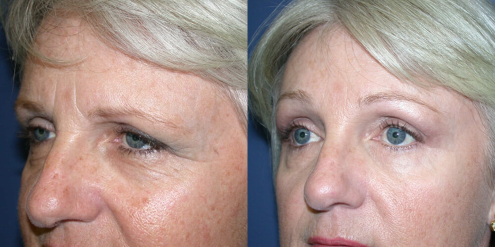 Before and After Image