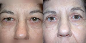 Before and After Image