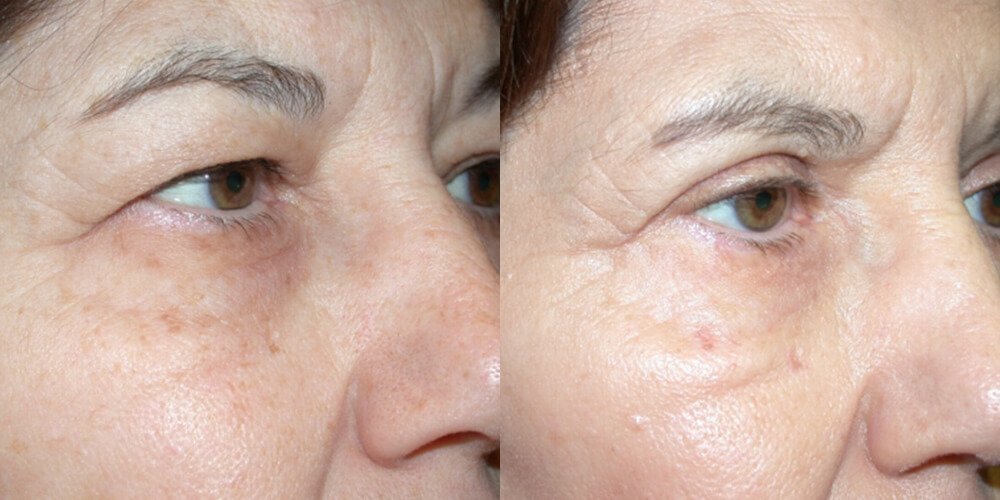 Before and After Image