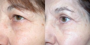 Before and After Image