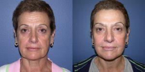 Before and After Image