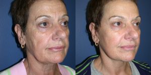 Before and After Image