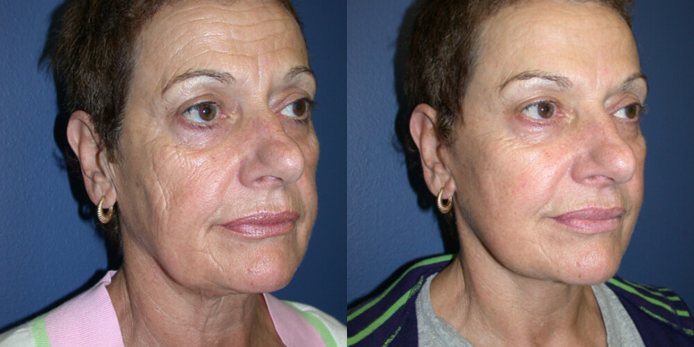 Before and After Image