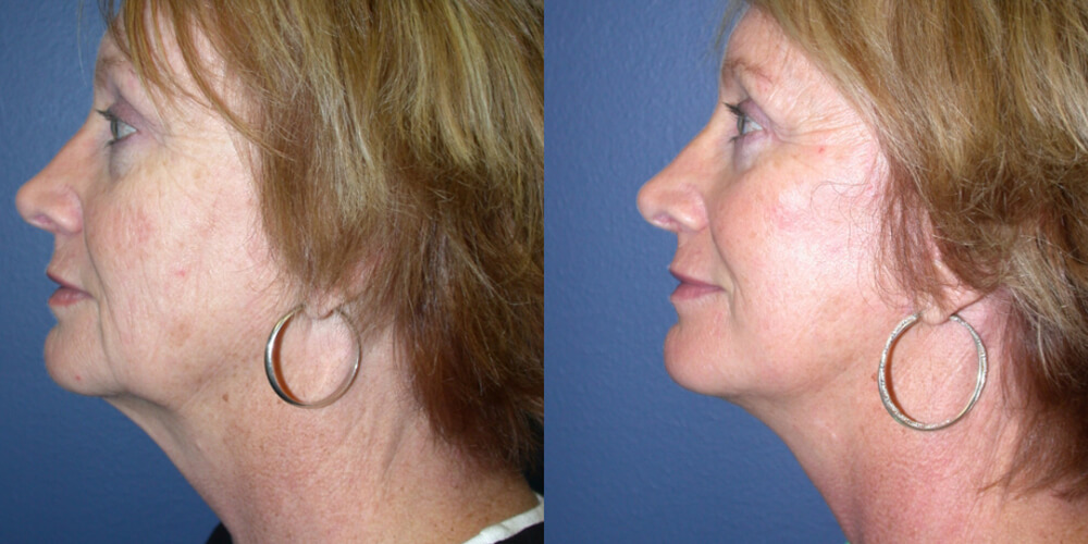 Before and After Image