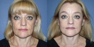 Before and After Image