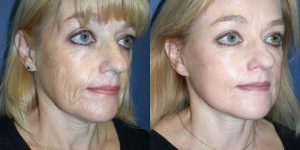 Before and After Image