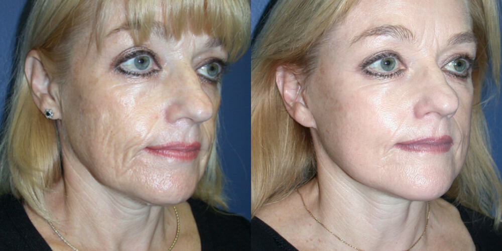 Before and After Image