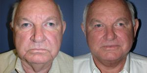 Before and After Image