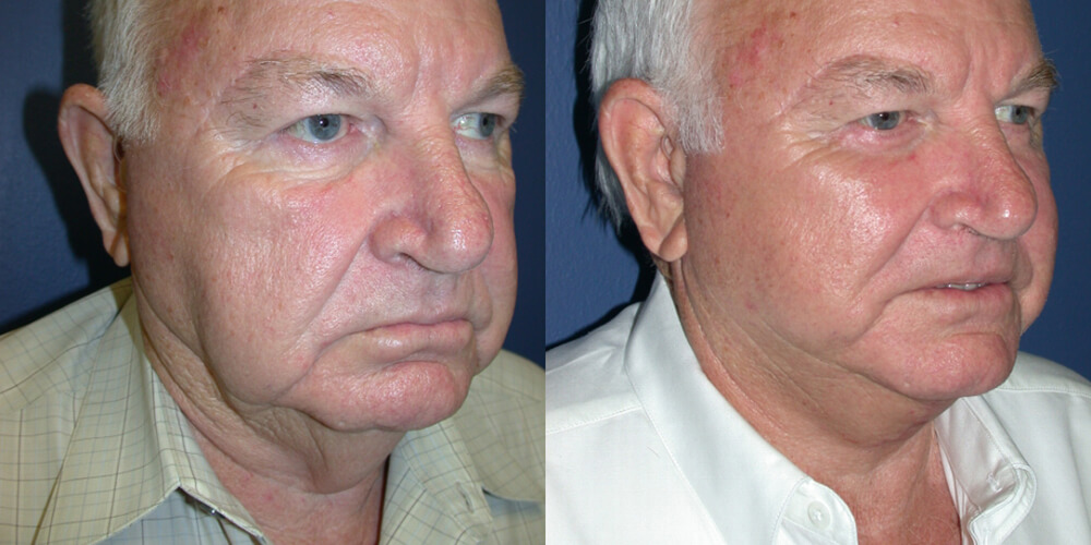 Before and After Image