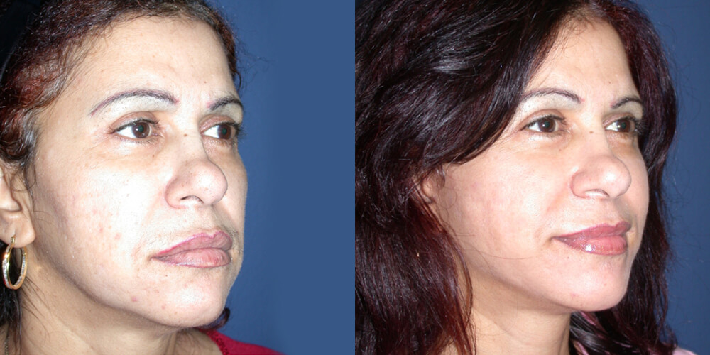 Before and After Image