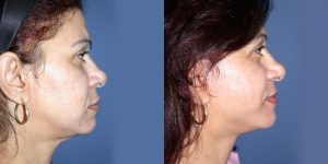 Before and After Image