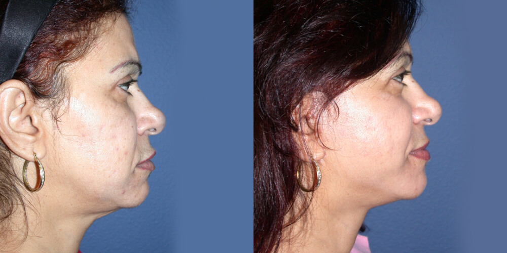 Before and After Image