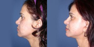 Before and After Image