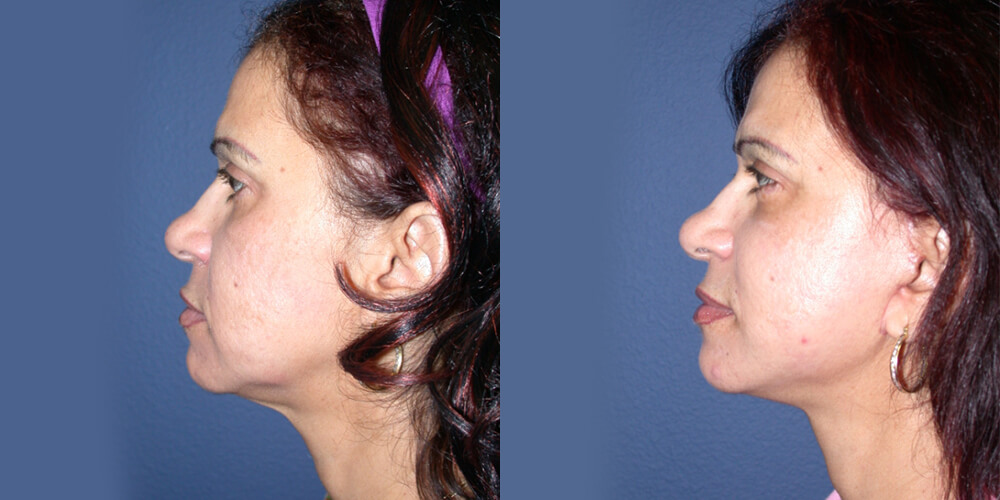 Before and After Image