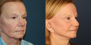 Before and After Image